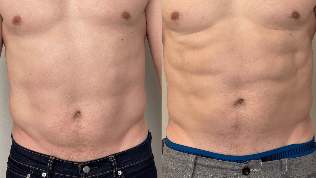 Before and after